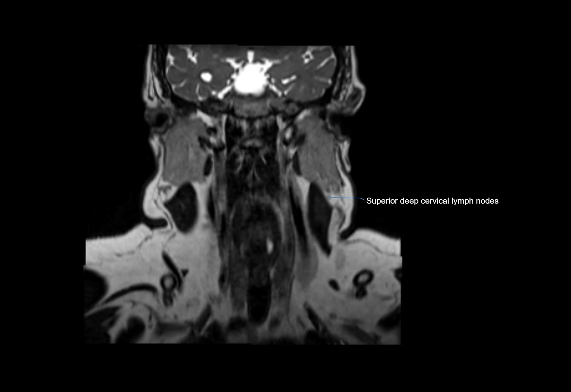 Neck coronal lymph node cross sectional MRI anatomy 3T MRI  image-img-00001-00036.webp